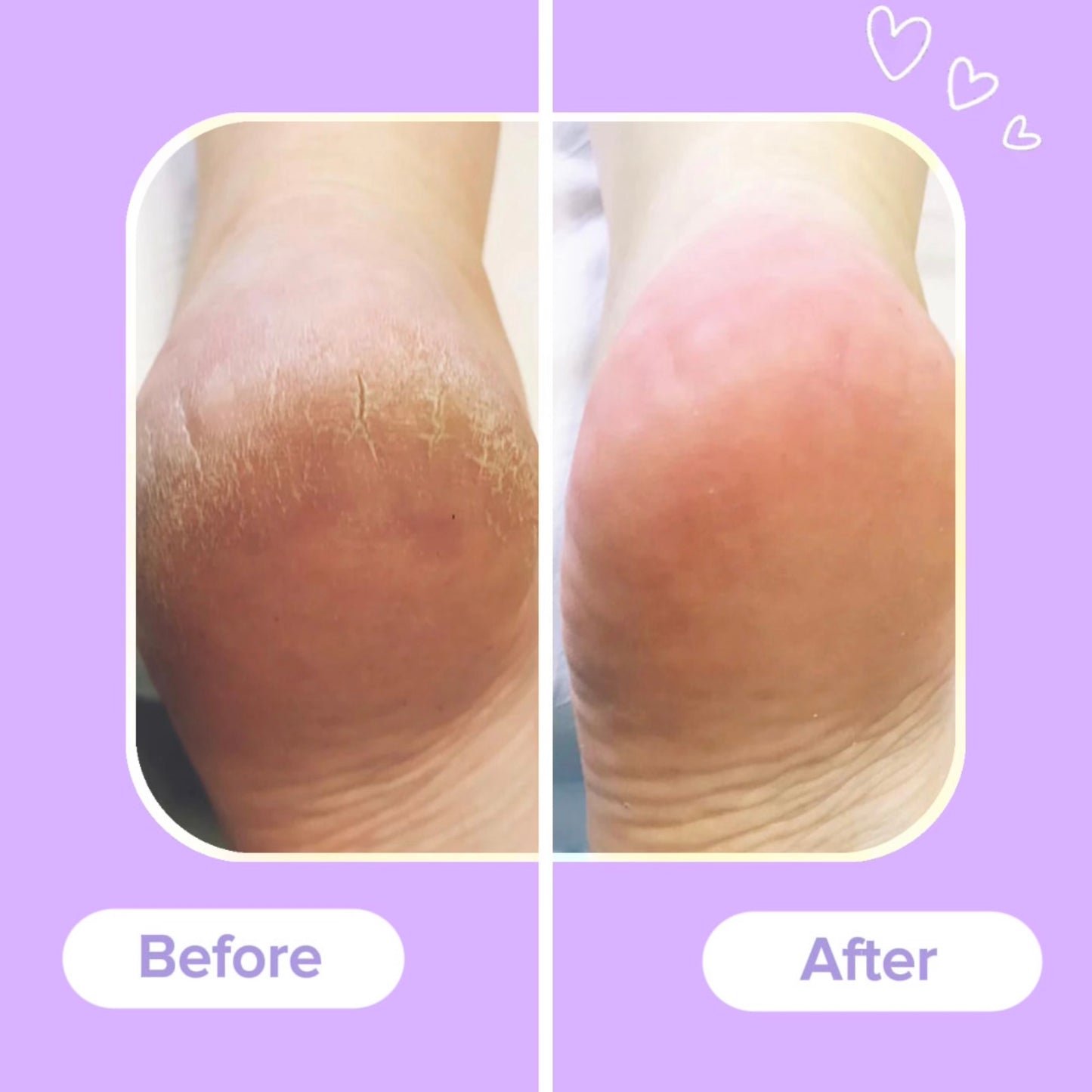 SoleSmooth™ Callus Remover