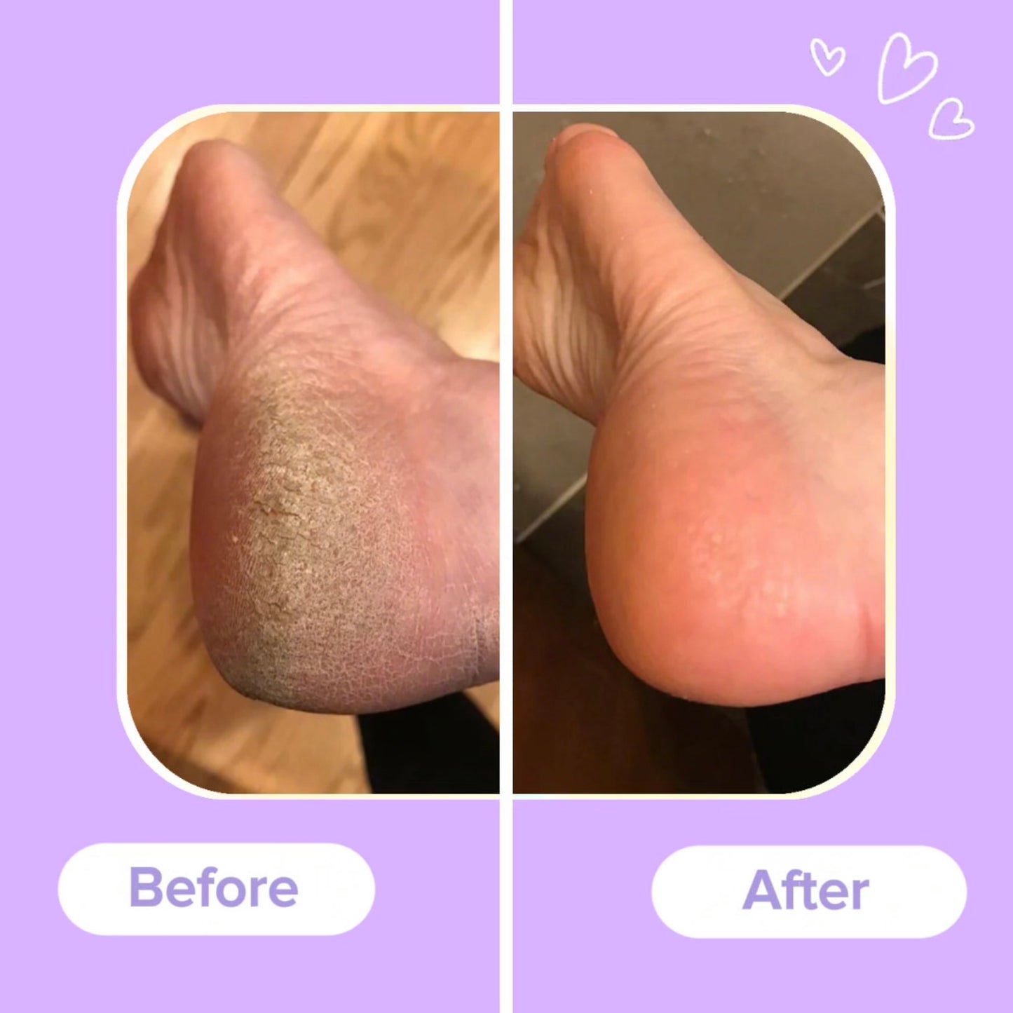 SoleSmooth™ Callus Remover