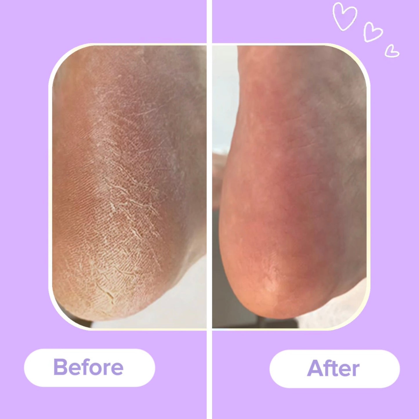 SoleSmooth™ Callus Remover