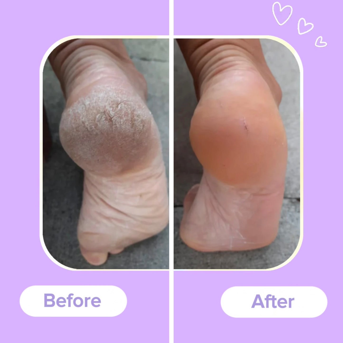 SoleSmooth™ Callus Remover